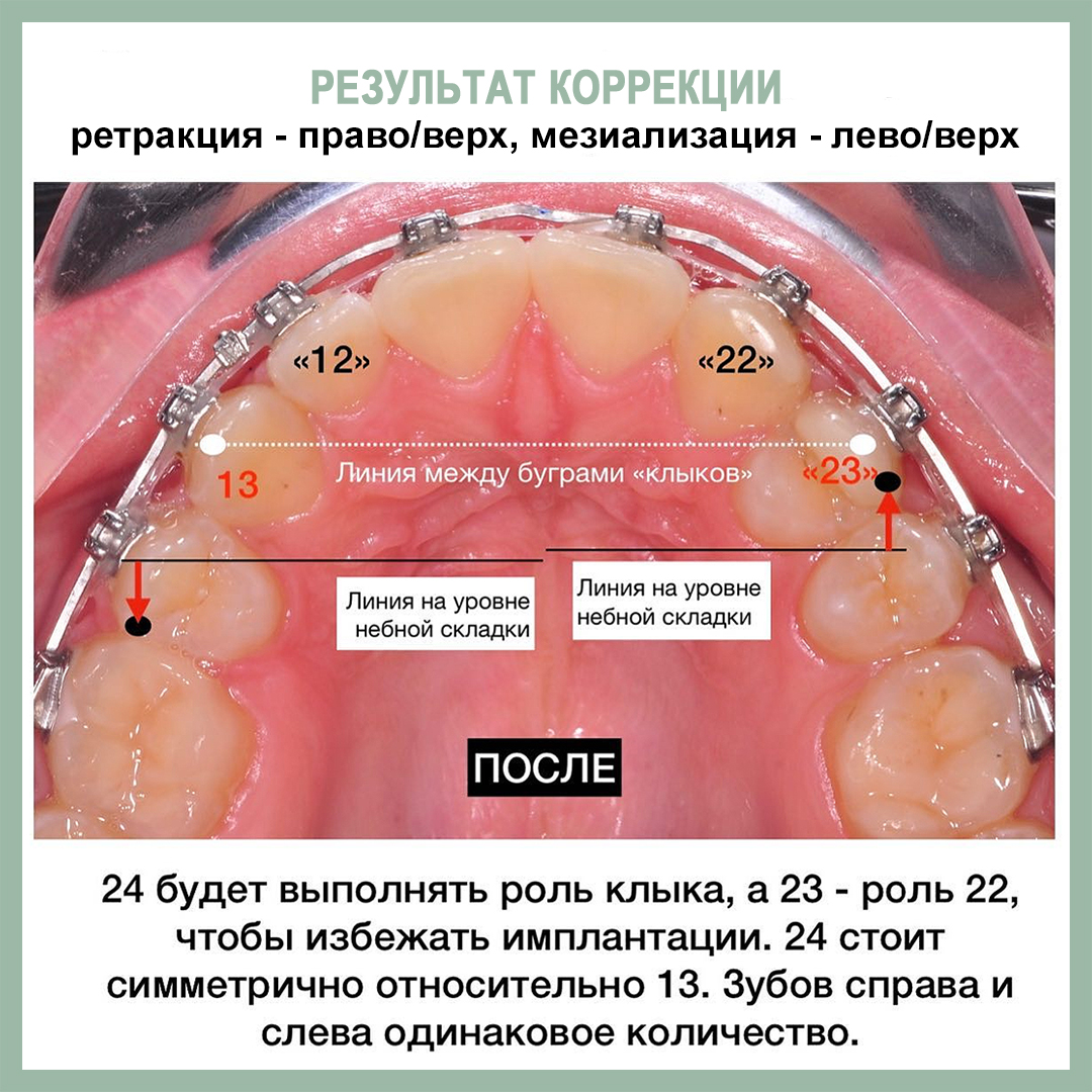 Опора на минивинты (МВ) в асимметричных случаях. - интересно об ортодонтии,  имплантации и протезировании зубов